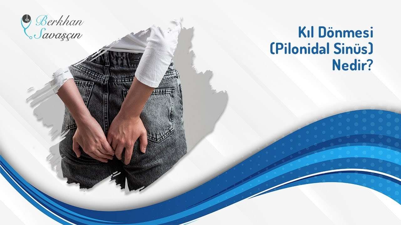kıl dönmesi,pilonidal sinüs