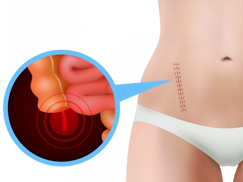 apandisit-patlamasi-nedir