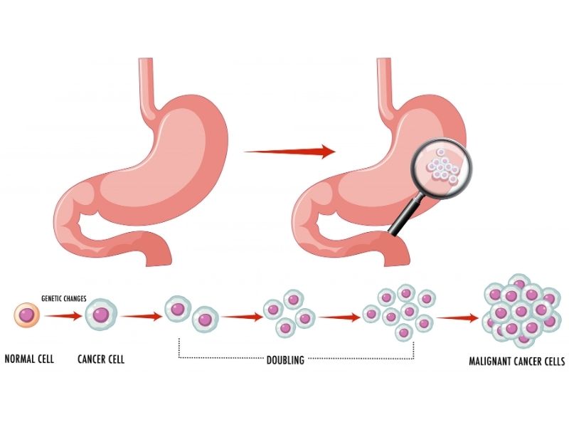 evre-0-karsinoma-in-situ-mide-kanseri-nedir