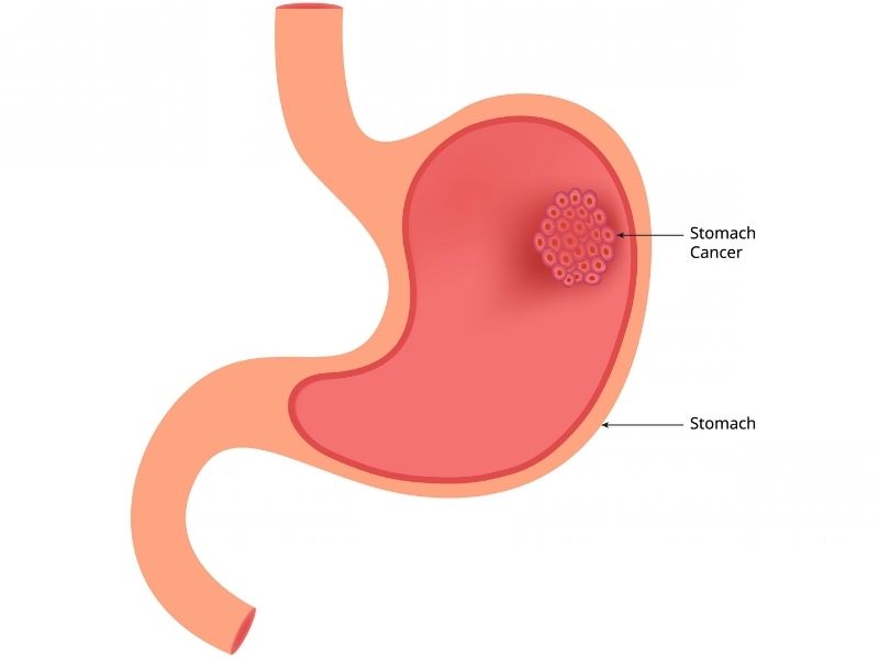 evre-4-metastatik-mide-kanseri-nedir
