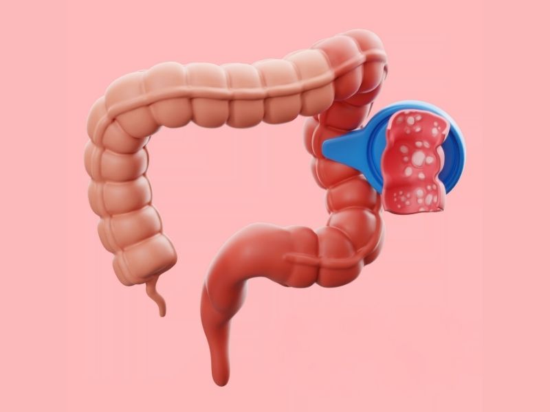 kolon-kanseri-kimlerde-gorulur