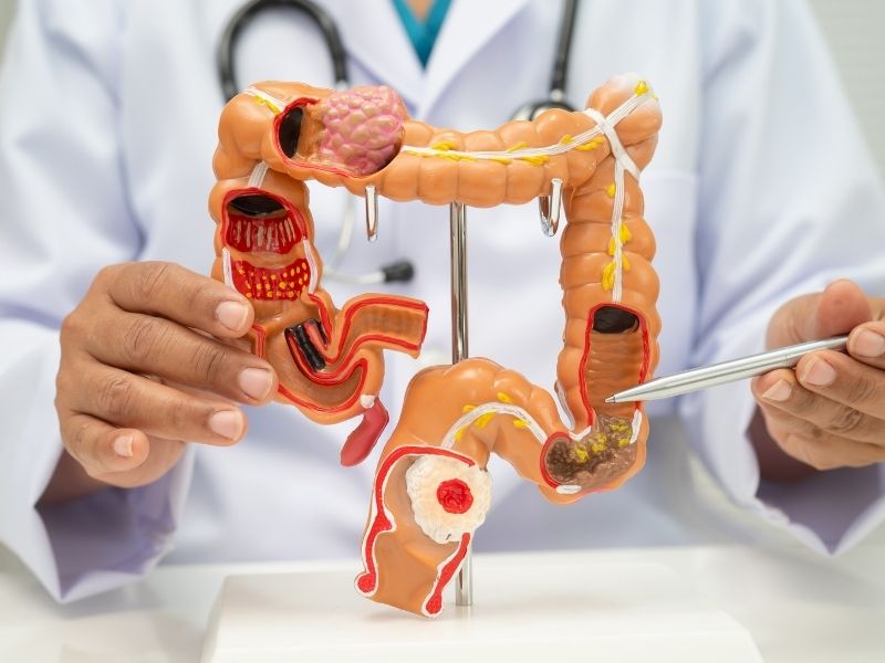 kolon-kanserinde-inflamatuvar-bagirsak-hastaliklari-ve-risk