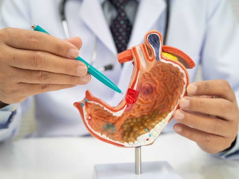 mide-kanseri-ameliyati-nasil-yapilir