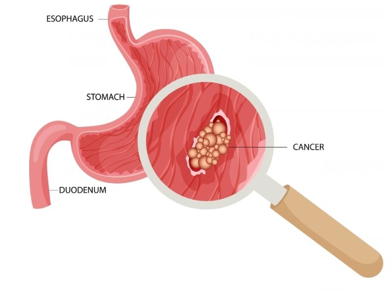 mide-kanseri-evreleri-ile-belirtiler-arasinda-iliski-var-mi