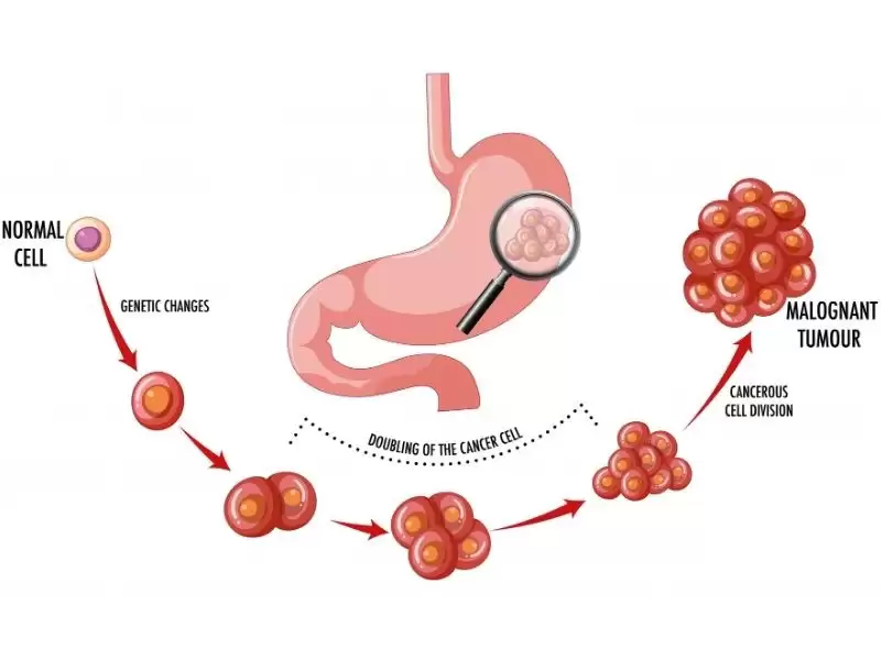 Mide Kanseri Evreleri