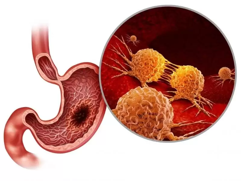 Mide Kanserini Anlamanın Yolları