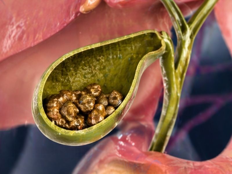 erkeklerde-safra-kesesi-tasi-neden-olur